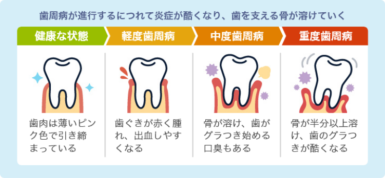 歯周病が重症化した時の症状